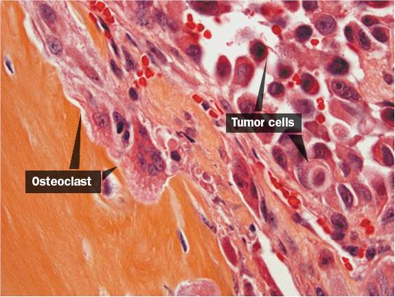 Kang cancer cells